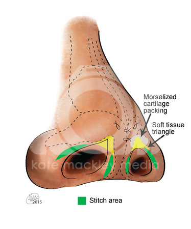 The Nose: Soft Tissue Triangle Notching